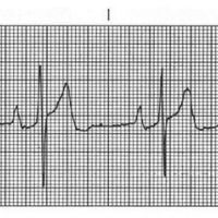 How much do I need to know about ECG’s to pass ACLS?